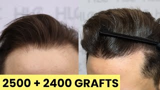 FUE Hair Transplant and Beard Transplant in Turkey  4900 Grafts [upl. by Atnoid]