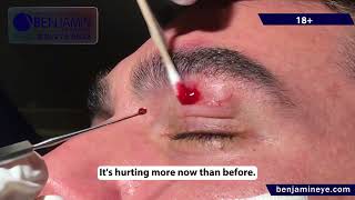 Epidermal Inclusion Cyst Removal [upl. by Nealon]