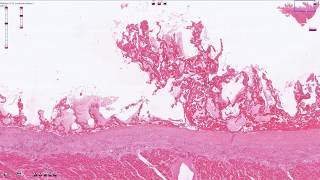 Fibrinous Pericarditis  Histopathology [upl. by Ozan]