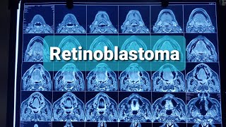 Retinoblastoma Orbital tumors Classification [upl. by Koh]