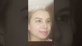 Wide Nose Rhinoplasty Surgery Before amp After Pictures nosejobbeforeandafter nosejobs [upl. by Allissa]