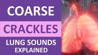 Coarse Crackles Lung Sounds Audio Causes Auscultation Nursing NCLEX Review [upl. by Eenot383]