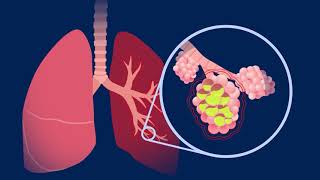 Understanding Pneumococcal Pneumonia [upl. by Nogem919]