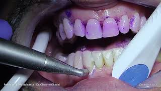 PROPHYLAXIS  Dr Giacomo Oldoini  Periodontal Mantainance [upl. by Edgerton]