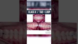 CLASS II  TAD  LOOP  ORTHODONTIC TIPS Shorts [upl. by Yhtimit145]