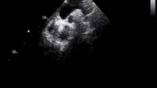 coarctation of the aorta and RHDmild mitral stenosis [upl. by Fidelio]