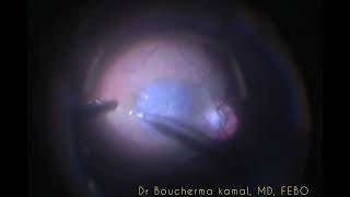 Amniotic Membrane Graft for Reccurent macular hole [upl. by Eisus]