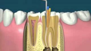 traitement endodontiquedevitalisationflv [upl. by Eserahs872]