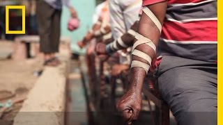 WATCH The Practice of Bloodletting in New Delhi  National Geographic [upl. by Eiwoh]