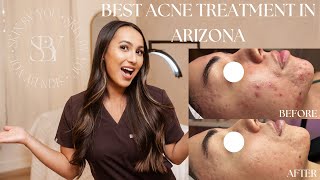 The Best Acne Treatment In Arizona [upl. by Gearhart]