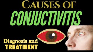 Understanding Conjunctivitis Causes Symptoms and Treatments [upl. by Tehcac98]