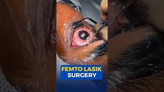 Femto Lasik Surgery [upl. by Ylrad890]