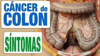 Cáncer de Colon  Síntomas [upl. by Orling863]