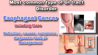 Understanding Esophageal Cancer  Symptoms Diagnosis and Treatment [upl. by Quinby]