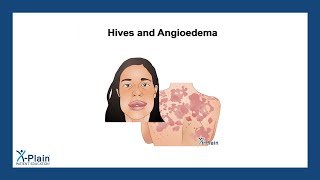 Hives and Angioedema [upl. by Ylesara62]