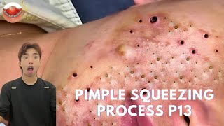 The MOST TERRIFYING Acne Squeezing Videos Youve Ever Seen 13 [upl. by Gunner968]