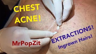 Chest congestionblackheads whiteheads ingrown hairs Multiple plugs extracted patient left happy [upl. by Yerok]