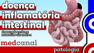 Doença Inflamatória Intestinal  PATOLOGIA [upl. by Ativ]