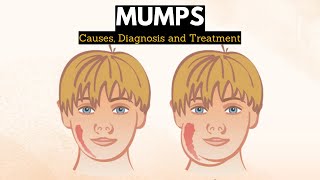 Mumps Causes Signs and Symptoms Diagnosis and Treatment [upl. by Octavus]