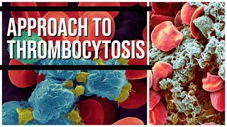 Approach to Thrombocytosis pathology pathologylab hematology hemepath [upl. by Couture]