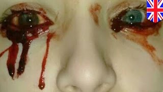 17yearold UK girl cries tears of blood but no one can figure out why [upl. by Faucher]