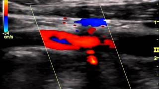 Internal Carotid Occlusion with Recanalizationwmv [upl. by Assiluy180]