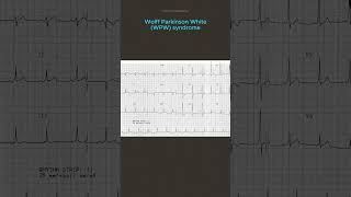 ECG Diagnosis [upl. by Doble]