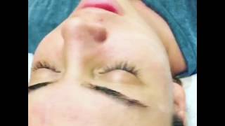 30 salicylic chemical peel at Skin at Alon Aesthetics Plastic Surgery [upl. by Hibben]