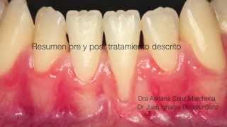 Cirugía Plástica Periodontal en recesión clase III [upl. by Imaj]