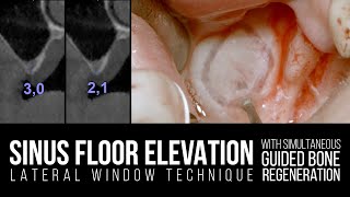 Maxillary Sinus Lift with Lateral Window Technique and Simultaneous GBR [upl. by Akire]