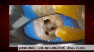 Treatment of a Cshaped canal by the SAF System  Dr Michael Solomonov [upl. by Oratnek]