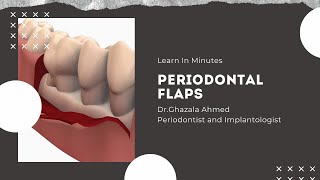 Periodontal Flaps [upl. by Artema268]