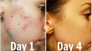 How I Got Rid of My Acne Scars Forever Guaranteed Clearer Skin in 3 Days [upl. by Tnomed]