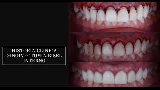 Gingivectomia a bisel interno caso clínico [upl. by Johnette]