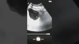 whole abdomen ultrasound [upl. by Alhsa]