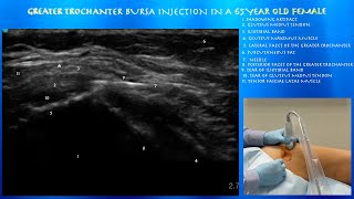 Ultrasound Guided Greater Trochanter Injection by probeultrasound [upl. by Llerej]