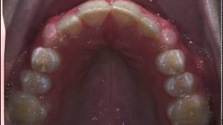 Orthodontic Expansion without a palatal expander [upl. by Magnuson287]