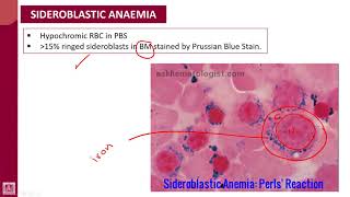 Hematology  1  U8L4  Sideroblastic anaemia [upl. by Roze]