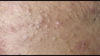 Squeezing blackheads on the forehead HoangMySpa70 [upl. by Meingolda]