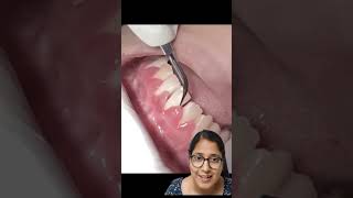 GINGIVAL INFLAMMATION  GINGIVITIS  shortsfeed youtubeshorts dentalclinic AS dental care viral [upl. by Philo5]