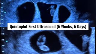 Our First Ultrasound at 5 Weeks amp 5 Days Its Five Finding Out We Were Having Quintuplets [upl. by Tore]