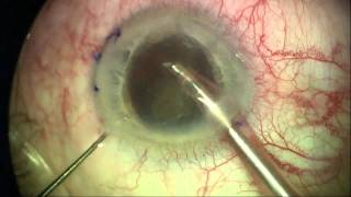 Cataract Surgery with a Limbal Relaxing Incision LRI to Correct Astigmatism [upl. by Aveer]