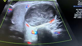 Ultrasound of pathologically confirmed case of pleomorphic adenoma of parotid gland [upl. by Lotty]