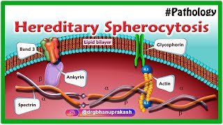 Hereditary Spherocytosis Animation  Etiology Pathology Clinical features Diagnosis and Treatment [upl. by Anilef]