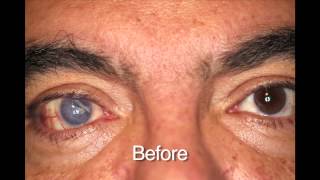 Custom Color Contacts  Prosthetic Before and Afters [upl. by Odnama]