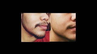 Minoxidil Beard 2 Months Transformation No Genetic [upl. by Einnim351]