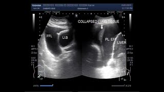 Pleural Effusion with mild ascites [upl. by Phoebe]