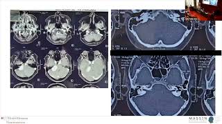 CP Angle Tumour Vestibular Schwannoma  MASSIN Congress Day 2  Session 4 Talk 2 [upl. by Goldia419]