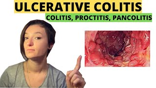 Ulcerative Colitis Proctitis Pancolitis How to heal naturally [upl. by Ardnuassak754]