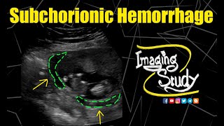 Subchorionic Hemorrhage  Ultrasound  Case 193 [upl. by Malanie]